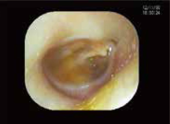 滲出性中耳炎の説明画像2